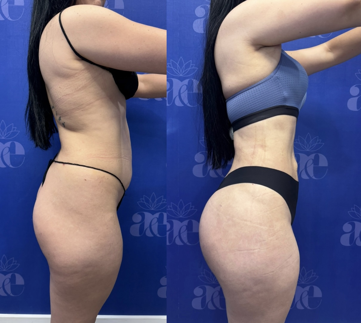 liposuction Before and After