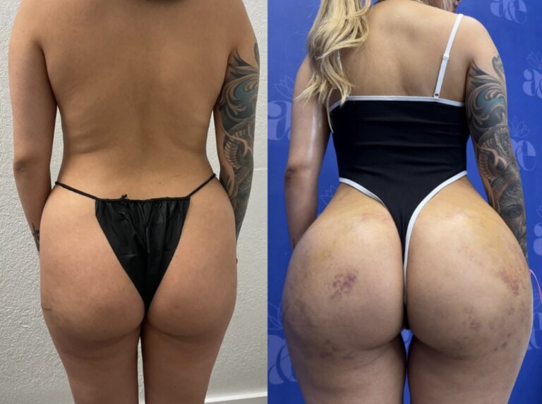 BBL in Miami: who can have it and what the results look like