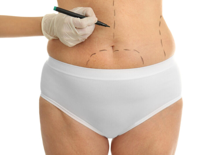 Liposuction in Miami: how the procedure works, results, and recovery